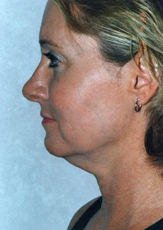 Facelift