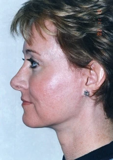 Facelift