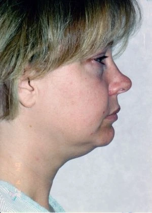 Facial Liposuction