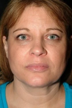Facial Liposuction