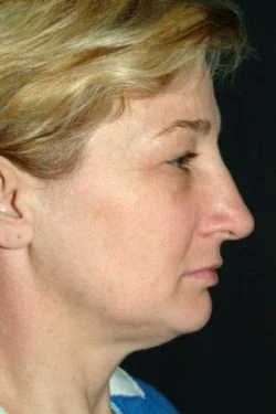 Facial Liposuction