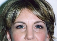Brow Lift