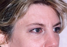 Brow Lift