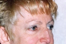 Brow Lift