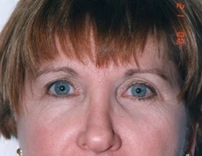 Brow Lift