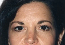 Brow Lift