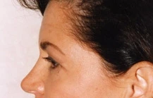 Brow Lift
