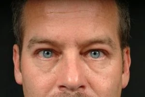 Blepharoplasty (Eyelid Surgery)