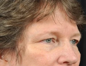 Blepharoplasty (Eyelid Surgery)