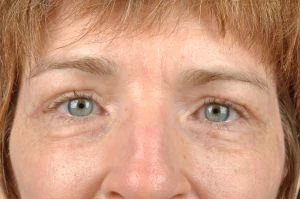Blepharoplasty (Eyelid Surgery)