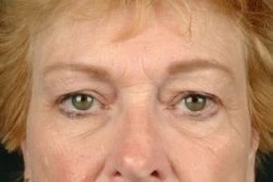 Blepharoplasty (Eyelid Surgery)