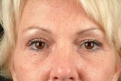 Blepharoplasty (Eyelid Surgery)
