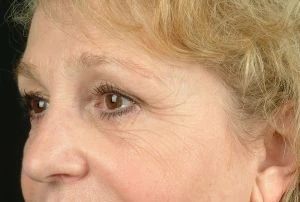 Blepharoplasty (Eyelid Surgery)