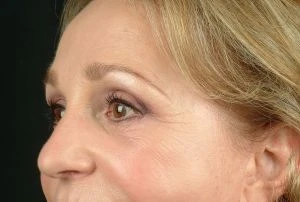 Blepharoplasty (Eyelid Surgery)