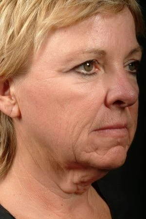 Blepharoplasty (Eyelid Surgery)