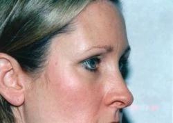 Blepharoplasty (Eyelid Surgery)