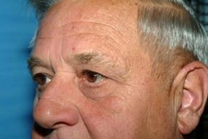 Blepharoplasty (Eyelid Surgery)