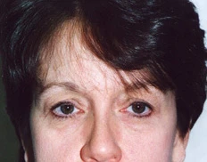 Blepharoplasty (Eyelid Surgery)