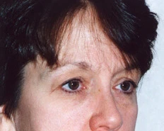 Blepharoplasty (Eyelid Surgery)