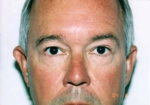 Blepharoplasty (Eyelid Surgery)