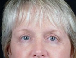 Blepharoplasty (Eyelid Surgery)