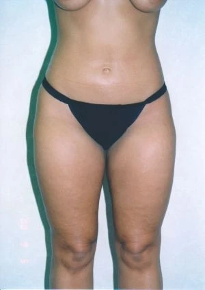 Liposuction