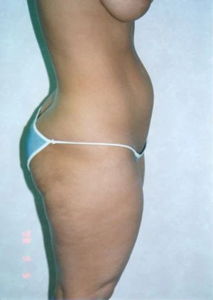 Liposuction