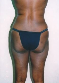 Liposuction