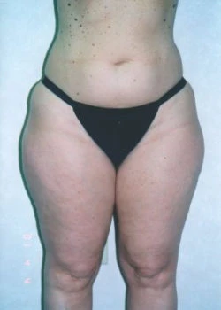 Liposuction