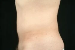 Liposuction