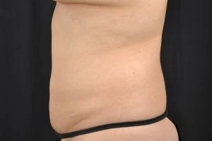 Liposuction