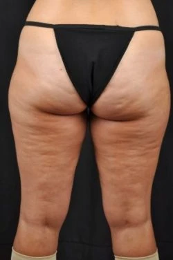 Liposuction