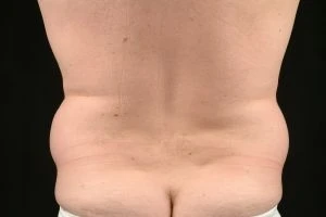 Liposuction