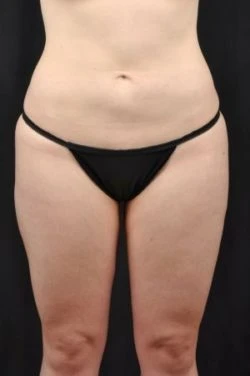 Liposuction