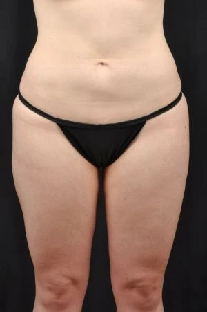 Liposuction