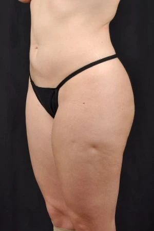 Liposuction