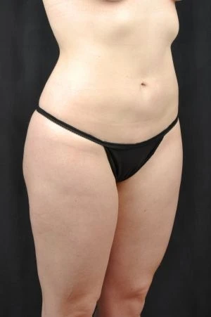 Liposuction