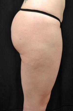 Liposuction