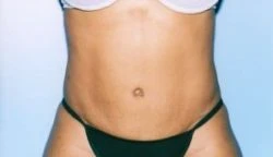 Tummy Tuck