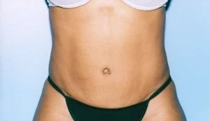 Tummy Tuck