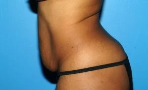 Tummy Tuck