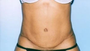 Tummy Tuck
