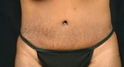 Tummy Tuck