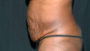 Tummy Tuck