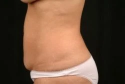 Tummy Tuck