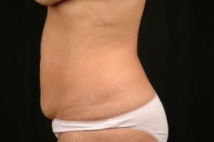 Tummy Tuck