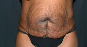 Tummy Tuck
