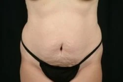 Tummy Tuck