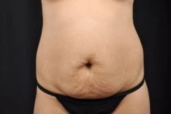 Tummy Tuck