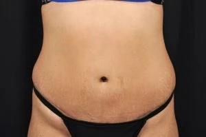 Tummy Tuck